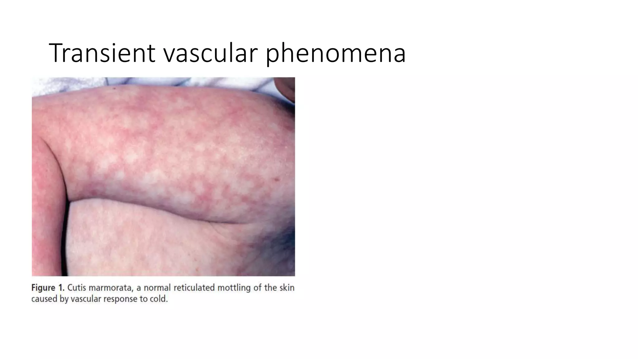Transient vascular phenomena
 