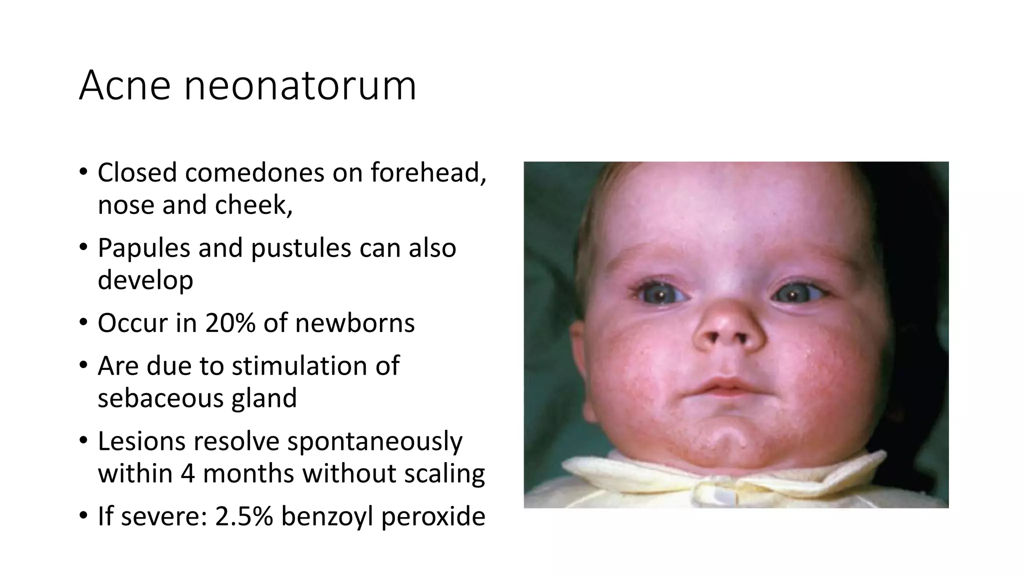 Acne neonatorum
• Closed comedones on forehead,
nose and cheek,
• Papules and pustules can also
develop
• Occur in 20% of newborns
• Are due to stimulation of
sebaceous gland
• Lesions resolve spontaneously
within 4 months without scaling
• If severe: 2.5% benzoyl peroxide
 