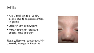 Milia
• Are 1-2mm white or yellow
papule due to keratin retention
in dermis
• Occur in 50% of newborn
• Mostly found on forehead,
cheeks, nose and chin
Usually, Resolve spontaneously in
1 month, may go to 3 months
 