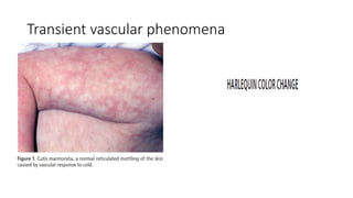 Transient vascular phenomena
 