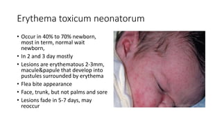 Erythema toxicum neonatorum
• Occur in 40% to 70% newborn,
most in term, normal wait
newborn,
• In 2 and 3 day mostly
• Lesions are erythematous 2-3mm,
macule&papule that develop into
pustules surrounded by erythema
• Flea bite appearance
• Face, trunk, but not palms and sore
• Lesions fade in 5-7 days, may
reoccur
 