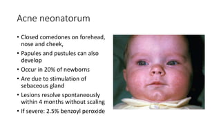 Acne neonatorum
• Closed comedones on forehead,
nose and cheek,
• Papules and pustules can also
develop
• Occur in 20% of newborns
• Are due to stimulation of
sebaceous gland
• Lesions resolve spontaneously
within 4 months without scaling
• If severe: 2.5% benzoyl peroxide
 
