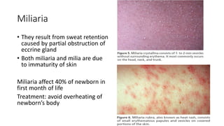 Miliaria
• They result from sweat retention
caused by partial obstruction of
eccrine gland
• Both miliaria and milia are due
to immaturity of skin
Miliaria affect 40% of newborn in
first month of life
Treatment: avoid overheating of
newborn’s body
 