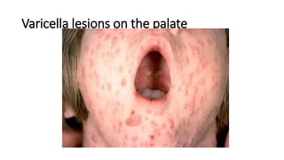 Varicella lesions on the palate
 