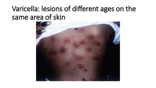 Varicella: lesions of different ages on the
same area of ​​skin
 