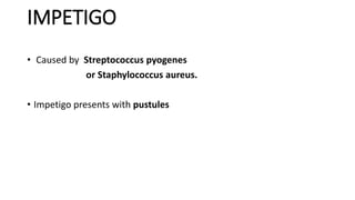 IMPETIGO
• Caused by Streptococcus pyogenes
or Staphylococcus aureus.
• Impetigo presents with pustules
 