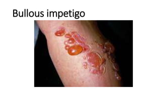 Bullous impetigo
 