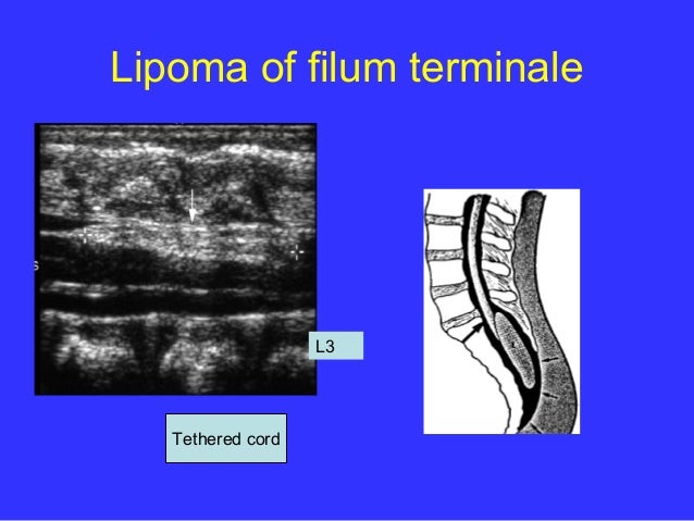 Filum Terminale Ultrasound : The filum terminale is an extension of the pia mater that is attached to the coccygeal segments filum terminale lipomas represent the most common intraspinal lipoma.
