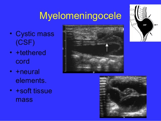 Neonatal spine ultrasound...normal and abnormal findings