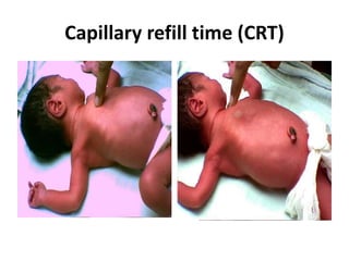 Capillary refill time (CRT)
 