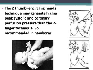 • The 2 thumb–encircling hands
technique may generate higher
peak systolic and coronary
perfusion pressure than the 2-
finger technique, So
recommended in newborns
 