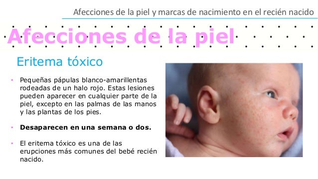 Atopichesky la dermatitis uryazh