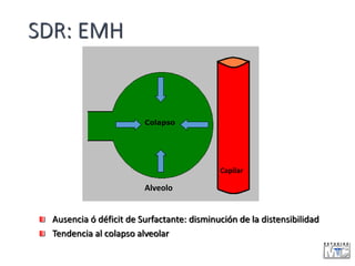 SDR: EMH
Ausencia ó déficit de Surfactante: disminución de la distensibilidad
Tendencia al colapso alveolar
Alveolo
Capila...