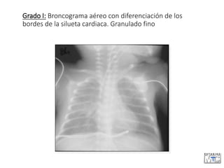 Grado I: Broncograma aéreo con diferenciación de los
bordes de la silueta cardiaca. Granulado fino
 