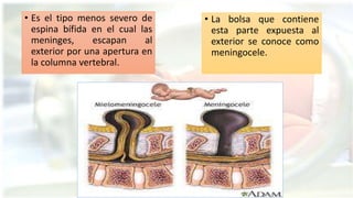 • Es el tipo menos severo de
espina bífida en el cual las
meninges, escapan al
exterior por una apertura en
la columna vertebral.
• La bolsa que contiene
esta parte expuesta al
exterior se conoce como
meningocele.
 