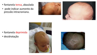 • fontanela tensa, abaulada
• pode indicar aumento da
pressão intracraniana.
• fontanela deprimida
• desidratação
 