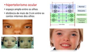 • hipertelorismo ocular
• espaço amplo entre os olhos
• distância de mais de 3 cm entre os
cantos internos dos olhos
 