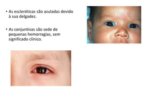 • As escleróticas são azuladas devido
à sua delgadez.
• As conjuntivas são sede de
pequenas hemorragias, sem
significado clínico.
 