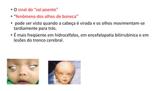 • O sinal do “sol poente”
• “fenômeno dos olhos de boneca”
• pode ser visto quando a cabeça é virada e os olhos movimentam-se
tardiamente para trás.
• É mais freqüente em hidrocéfalos, em encefalopatia bilirrubínica e em
lesões do tronco cerebral.
 