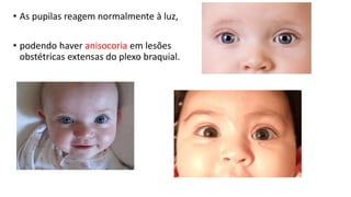 • As pupilas reagem normalmente à luz,
• podendo haver anisocoria em lesões
obstétricas extensas do plexo braquial.
 