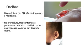 Orelhas
• Os pavilhões, nos RN, são muito moles
e moldáveis.
• No prematuro, freqüentemente
permanece dobrado o pavilhão sobre o
qual repousa a criança em decúbito
lateral.
•
 