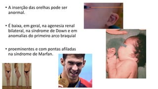 • A inserção das orelhas pode ser
anormal.
• É baixa, em geral, na agenesia renal
bilateral, na síndrome de Down e em
anomalias do primeiro arco braquial
• proeminentes e com pontas afiladas
na síndrome de Marfan.
 