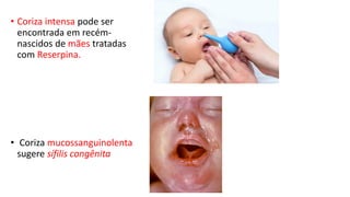 • Coriza intensa pode ser
encontrada em recém-
nascidos de mães tratadas
com Reserpina.
• Coriza mucossanguinolenta
sugere sífilis congênita
 