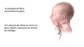 A salivação do RN é
normalmente pobre.
Um excesso de saliva ou muco na
boca impõe a pesquisa de atresia
do esôfago.
 