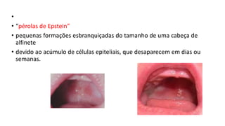 •
• “pérolas de Epstein”
• pequenas formações esbranquiçadas do tamanho de uma cabeça de
alfinete
• devido ao acúmulo de células epiteliais, que desaparecem em dias ou
semanas.
 