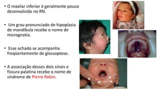 • O maxilar inferior é geralmente pouco
desenvolvido no RN.
• Um grau pronunciado de hipoplasia
de mandíbula recebe o nome de
micrognatia.
• Esse achado se acompanha
freqüentemente de glossoptose.
• A associação desses dois sinais e
fissura palatina recebe o nome de
síndrome de Pierre Robin.
 