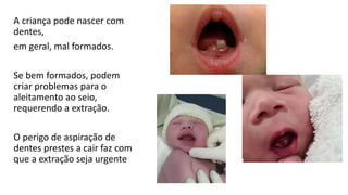 A criança pode nascer com
dentes,
em geral, mal formados.
Se bem formados, podem
criar problemas para o
aleitamento ao seio,
requerendo a extração.
O perigo de aspiração de
dentes prestes a cair faz com
que a extração seja urgente
 