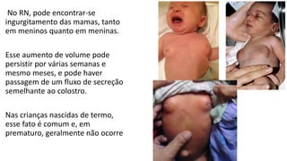 No RN, pode encontrar-se
ingurgitamento das mamas, tanto
em meninos quanto em meninas.
Esse aumento de volume pode
persistir por várias semanas e
mesmo meses, e pode haver
passagem de um fluxo de secreção
semelhante ao colostro.
Nas crianças nascidas de termo,
esse fato é comum e, em
prematuro, geralmente não ocorre
 