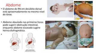 Abdome
• O abdome do RN em decúbito dorsal
está aproximadamente no mesmo nível
do tórax.
• Abdome abaulado nas primeiras horas
pode sugerir obstrução intestinal,
enquanto abdome escavado sugere
hérnia diafragmática.
•
 