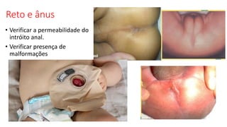 Reto e ânus
• Verificar a permeabilidade do
intróito anal.
• Verificar presença de
malformações
 