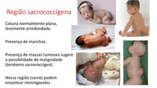 Região sacrococcígena
Coluna normalmente plana,
levemente arredondada.
Presença de manchas.
Presença de massas tumorais sugere
a possibilidade de malignidade
(teratoma sacrococcígeo).
Nessa região (sacro) podem
encontrar meningoceles
 