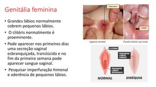 Genitália feminina
• Grandes lábios normalmente
cobrem pequenos lábios.
• O clitóris normalmente é
proeminente.
• Pode aparecer nos primeiros dias
uma secreção vaginal
esbranquiçada, translúcida e no
fim da primeira semana pode
aparecer sangue vaginal.
• Pesquisar imperfuração himenal
e aderência de pequenos lábios.
 