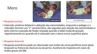 Moro
• Resposta normal
• Extensão simétrica bilateral e abdução das extremidades, enquanto o polegar e o
indicador formam um “c” característico, são seguidas pela adução das extremidades e
pelo retorno à posição de flexão relaxada quando o bebê muda de posição
repentinamente ou quando ele é colocado com o dorso numa superfície plana.
• Resposta Anormal
• Resposta assimétrica pode ser observada com lesões de nervo periférico (com plexo
braquial) ou fratura da clavícula ou da perna. Ausência de respostas em casos de
lesões graves do SNC
 