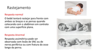 Rastejamento
Resposta normal
O bebê tentará rastejar para frente com
ambos os braços e as pernas quando
colocando com o abdômen em contrato
com uma superfície plana.
Resposta Anormal
Resposta assimétrica pode ser
observada com lesão de SNC ou de
nervo periférico ou com fratura do osso
longo da perna.
 