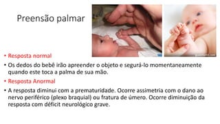Preensão palmar
• Resposta normal
• Os dedos do bebê irão apreender o objeto e segurá-lo momentaneamente
quando este toca a palma de sua mão.
• Resposta Anormal
• A resposta diminui com a prematuridade. Ocorre assimetria com o dano ao
nervo periférico (plexo braquial) ou fratura de úmero. Ocorre diminuição da
resposta com déficit neurológico grave.
 
