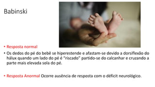 Babinski
• Resposta normal
• Os dedos do pé do bebê se hiperestende e afastam-se devido a dorsiflexão do
hálux quando um lado do pé é “riscado” partido-se do calcanhar e cruzando a
parte mais elevada sola do pé.
• Resposta Anormal Ocorre ausência de resposta com o déficit neurológico.
 