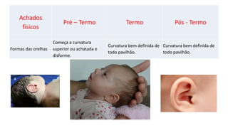 Achados
físicos
Pré – Termo Termo Pós - Termo
Formas das orelhas
Começa a curvatura
superior ou achatada e
disforme.
Curvatura bem definida de
todo pavilhão.
Curvatura bem definida de
todo pavilhão.
 