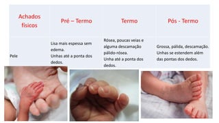 Achados
físicos
Pré – Termo Termo Pós - Termo
Pele
Lisa mais espessa sem
edema.
Unhas até a ponta dos
dedos.
Rósea, poucas veias e
alguma descamação
pálido-rósea.
Unha até a ponta dos
dedos.
Grossa, pálida, descamação.
Unhas se estendem além
das pontas dos dedos.
 