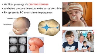 • Verificar presença de cranioestenose
• soldadura precoce de sutura entre ossos do crânio
• RN apresenta PC anormalmente pequenos.
 