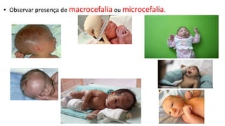 • Observar presença de macrocefalia ou microcefalia.
 