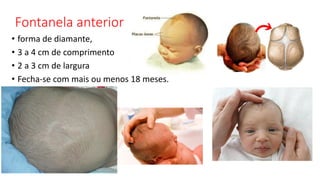 Fontanela anterior
• forma de diamante,
• 3 a 4 cm de comprimento
• 2 a 3 cm de largura
• Fecha-se com mais ou menos 18 meses.
 