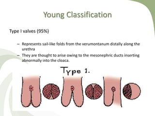 Young Classification
Type I valves (95%)
– Represents sail-like folds from the verumontanum distally along the
urethra
– They are thought to arise owing to the mesonephric ducts inserting
abnormally into the cloaca.
 