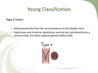 Young Classification
Type II valves
– Extend proximally from the verumontanum to the bladder neck.
– Likely have only historical significance and are not considered to be a
clinical entity, but rather hypertrophied urethral folds
 