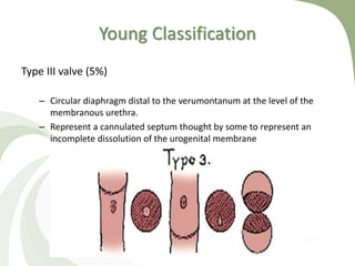 Young Classification
Type III valve (5%)
– Circular diaphragm distal to the verumontanum at the level of the
membranous urethra.
– Represent a cannulated septum thought by some to represent an
incomplete dissolution of the urogenital membrane
 