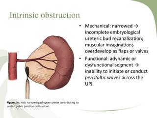 Intrinsic obstruction
• Mechanical: narrowed →
incomplete embryological
ureteric bud recanalization;
muscular invaginations
overdevelop as flaps or valves.
• Functional: adynamic or
dysfunctional segment →
inability to initiate or conduct
peristaltic waves across the
UPJ.
Figure: Intrinsic narrowing of upper ureter contributing to
ureteropelvic junction obstruction.
 