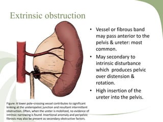 Extrinsic obstruction
• Vessel or fibrous band
may pass anterior to the
pelvis & ureter: most
common.
• May secondary to
intrinsic disturbance
which produces pelvic
over distension &
rotation.
• High insertion of the
ureter into the pelvis.
Figure: A lower pole–crossing vessel contributes to significant
kinking at the ureteropelvic junction and resultant intermittent
obstruction. Often, when the ureter is mobilized, no evidence of
intrinsic narrowing is found. Insertional anomaly and peripelvic
fibrosis may also be present as secondary obstructive factors.
 